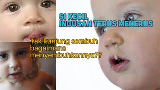 Anak ingusan terus  hidung meler  pilek gak sembuh sembuh  flu terus menerus  alergi [upl. by Crofoot]