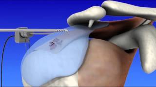 Shoulder Arthroscopy [upl. by Adnauqal722]