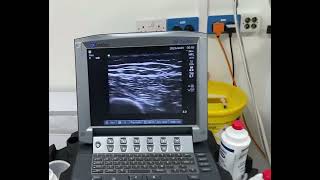 Scanning technique for adductor canal block [upl. by Eimareg]