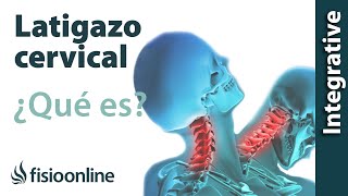 Latigazo cervical  ¿Qué es y cuáles son las claves de su solución [upl. by Gleich]