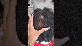 transformation 🔥alopecia canada 4c france hairstyle hair trending cheveux afrohair viral [upl. by Arhez]