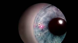 Laser Peripheral Iridotomy with a Model Eye [upl. by Naillimxam]