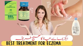 Eczema TreatmentHere is Homeopathic Solutions That Work [upl. by Clemen]