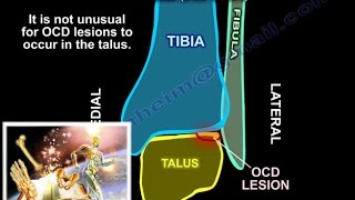 Osteochondral Lesions Of The Talus  Everything You Need To Know  Dr Nabil Ebraheim [upl. by Atsocal]