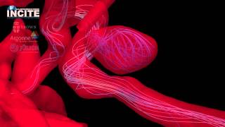 Multiscale Simulation of Blood Flow in Brain Arteries with an Aneurysm [upl. by Tilford179]