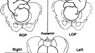 اسهل طريقة لتحديد malposition and malpresentation  مادة توليد obstetrics [upl. by Jessey809]