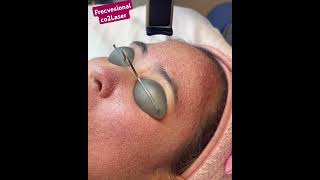 co2 Laser acne treatment skincare hydrafacialmd hydrafacialnation likeandsubscribe [upl. by Kelton895]