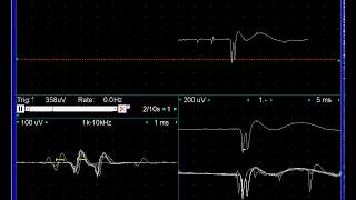 fibrillation amp positive sharp waves waxing amp waning [upl. by Lrac]