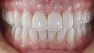 Лечение стираемости зубов Реставрация зубов по силиконовому ключу Front teeth restoration [upl. by Prinz446]