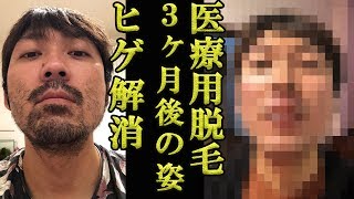 【永久脱毛】医療用脱毛で髭と完全におさらば！レーザー脱毛開始して3ヶ月記録【男性必見】 [upl. by Gautea]