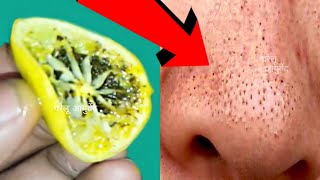 सर्फ 5 मिनट में ब्लैकहेड्स और वाइटहेड्स खत्म करें blackheads amp whiteheads remove fast in 5 minutes [upl. by Annawak168]