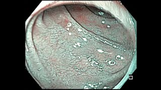 Celiac disease Endoscopic findings [upl. by Akoyn]