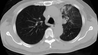 Lymphangitis carcinomatosis Ahuja AT et al 2017 Book Essential Radiology [upl. by Kiehl]