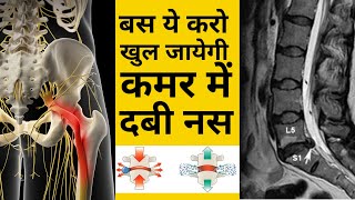 बस ये करो ठीक हो जाएगी कमर में दबी नस  L4L5 disc Bulge  SCIATICA  DABI NAS  leg pain  Hip pain [upl. by Airetahs154]