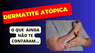 DERMATITE ATÓPICA O QUE AINDA NÃO TE CONTARAM [upl. by Siaht]