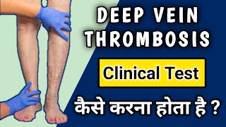 Deep vein thrombosis Clinical Examination  Homans Test for DVT [upl. by Esther]