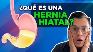 ¿QUÉ ES UNA HERNIA HIATAL [upl. by Danieu]