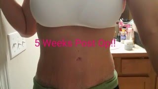 Mommy Makeover Secrets to Healing Well 5 weeks post op [upl. by Kcirrem103]