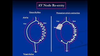 AV Nodal Reentry Supraventricular tachycardia  Definition Causes Symptoms Treatment [upl. by Dionisio412]