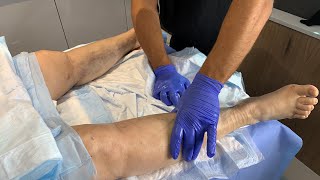 HOW TO REDUCE SWELLINGCOMPLICATIONS SCAR TISSUE AFTER LIPOSUCTION LYMPHATIC MASSAGEDr Jason Emer [upl. by Kalle169]