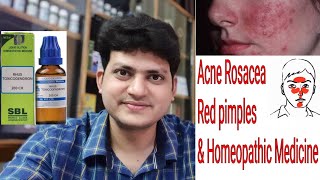 Acne Rosacea  Red Pimples  Homeopathic medicine for Rosacea  explain [upl. by Reseda]