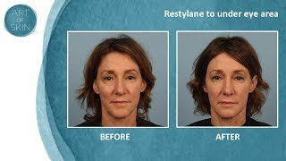 Undereye filler with Restylane Dr Palm San Diego [upl. by Felton265]