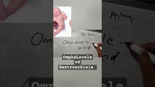 OmphaLocele vs gastroschisis shorts ytshorts fmgeians neetpg medicine [upl. by Frederica155]