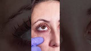 Fixing Hollow Eyes with Under Eye Filler [upl. by Hales]