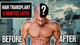 Hair Transplant Results After 6 Months  Before amp After [upl. by Yenaled182]