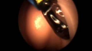 Balloon Sinuplasty for Chronic Sinusitis [upl. by Phionna]