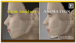 Chin Implant Animation Video  How is a chin implant inserted [upl. by Eceirtal912]