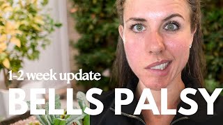 Bells Palsy  Days 714 Symptoms Home Remedies amp Treatments [upl. by Merrielle47]