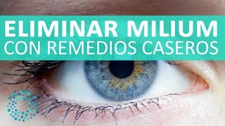 Cómo eliminar MILIUM con REMEDIOS CASEROS [upl. by Loretta]