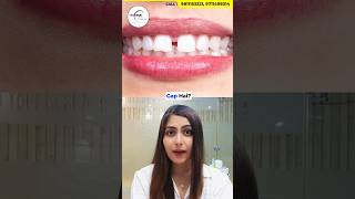 Do you have Teeth Gaps Watch this Dr Srishti Bhatia gaps smilemakeover teethgapmakeover [upl. by Som859]