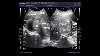 Ultrasound Video showing two large masses in cul de sac [upl. by Zulaledairam]