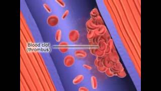 Formation of Deep Vein Thrombosis [upl. by Gnanmos]