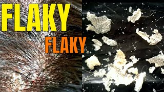 BIG FLAKES  Scalp Psoriasis Removal [upl. by Bud178]