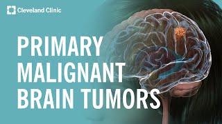 What Are Primary Malignant Brain Tumors [upl. by Annairda]