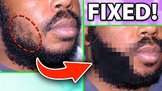 FUE Beard Hair Transplant 900 Grafts African American Man [upl. by Aniweta]