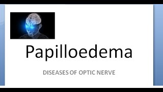 Ophthalmology Papilledema amaurosis fugax sometimes loss of vision cant see Hayreh theory [upl. by Harlow]