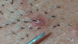 Biggest Ingrown Hair Removed from Beard 2019 [upl. by Azzil]