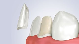 Cementazione faccetta dentale in disilicato di litio step by step [upl. by Ahseekan]