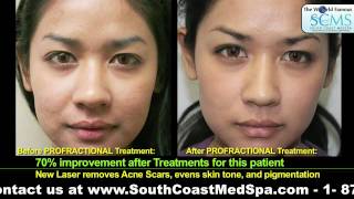 Acne Scar Removal Results [upl. by Elam]