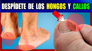 Este remedio quita los hongos y callos de los pies en solo 2 días [upl. by Mattias907]