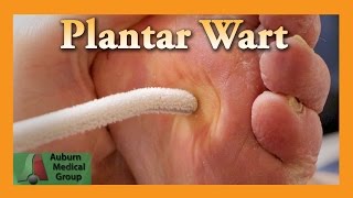 Plantar Wart Treatment  Auburn Medical Group [upl. by Nylcaj]