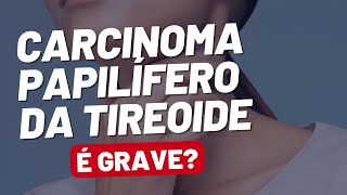 Carcinoma Papilífero de Tireoide o Câncer Mais Comum da Tireoide [upl. by Aikimat804]