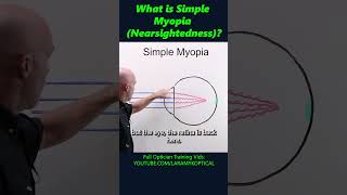 What is simple Myopia Nearsightedness [upl. by Ecitnerp]