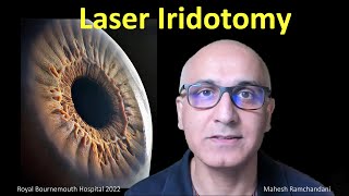 Laser Iridotomy the works Mahesh Ramchandani explores all about laser for angle closure glaucoma [upl. by Ditmore]