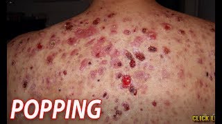 Severe Back Acne What is Bacne [upl. by Llewsor653]