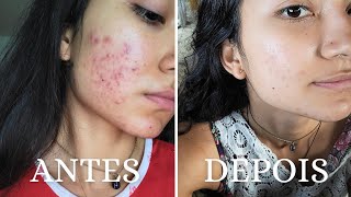 Como CURAR ACNE HORMONAL naturalmente [upl. by Annawak]